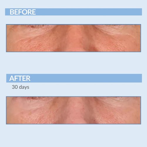 Serious Skincare A Force XR Serum Retinol Concentrate - Vitamin A - Time Released – Lightweight Anti-Aging & Anti-Wrinkle Facial Treatment – Green Tea Leaf Extract - 2 oz.