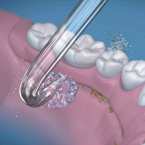 Waterpik Cordless Pearl Water Flosser Rechargeable Portable Water Flosser for Teeth, Gums & Genuine Implant Denture Replacement Tips, Water Flosser Tip Replacement, DT-100E, 2 Count
