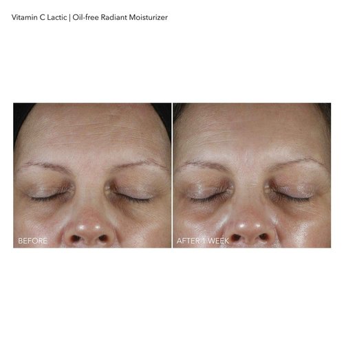 Dr Dennis Gross Vitamin C Lactic Oil-Free Radiant Moisturizer: For Dullness, Uneven Tone & Texture, Fine Lines and Occasional Dryness, 1.7 oz