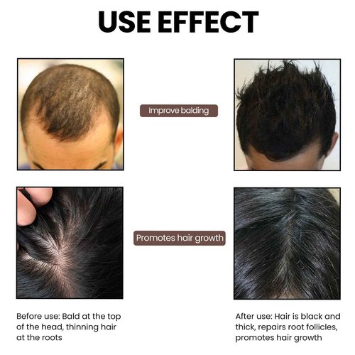 Thicair Hair Regrowth System - Volumizing Treatment with Copper Peptides & Collagen | Knotweed + Ginseng Root Extract | Supports Fuller, Healthier Looking Hair for Men & Women